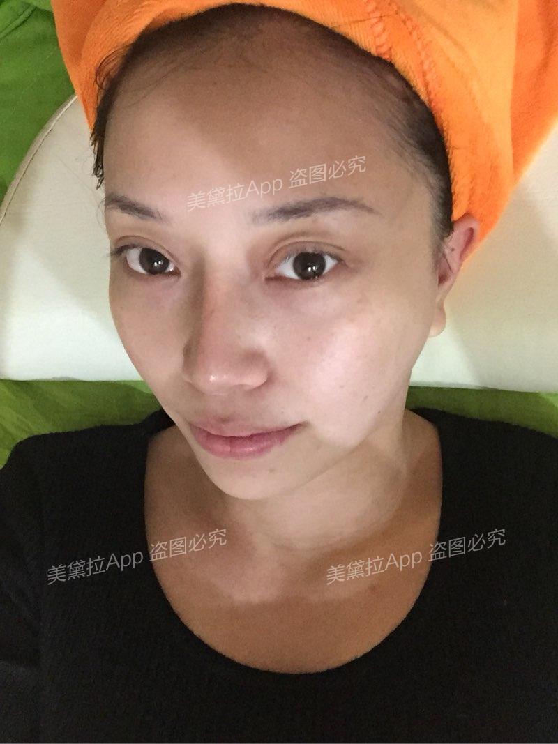 以色列深蓝射频,瘦脸塑型打造小V脸!