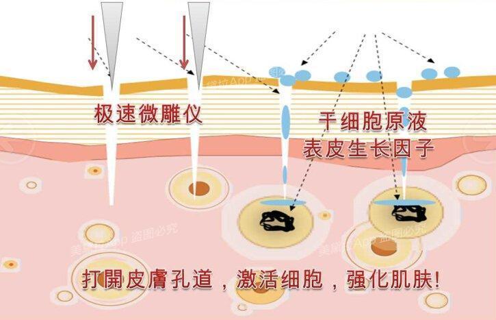 长痘原因你知吗?快看适合哪种医美祛痘