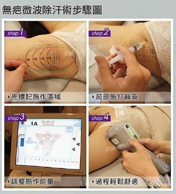 台湾微波除汗术,和腋下多汗有味说拜拜