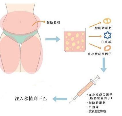 自体脂肪垫下巴